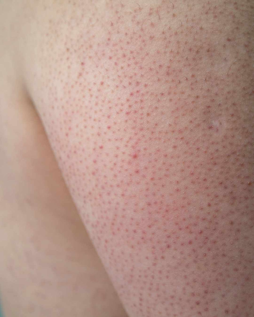 keratosis pilaris on upper arm