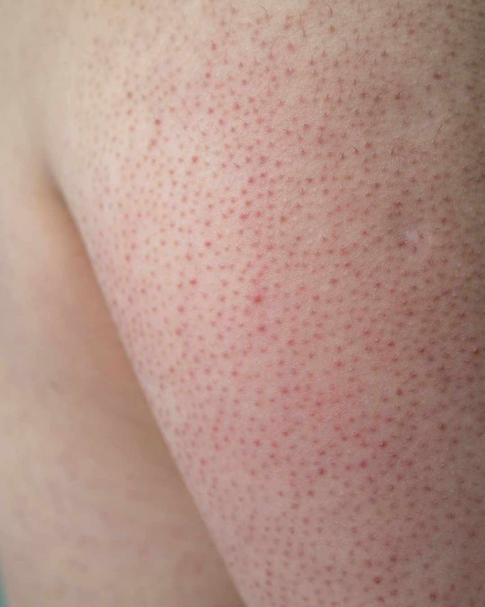 Managing Keratosis Pilaris: Smooth Bumpy Skin