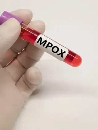 Advierten sobre transmisión del mpox, con casos notificados en 26 países este mes