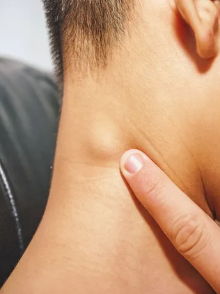 ¡Conozca los síntomas del linfoma de Hodgkin!