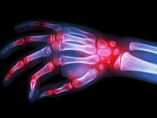 ¿Más molestias articulares en invierno? 