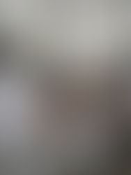 Brote de paperas en centros de detención migratoria