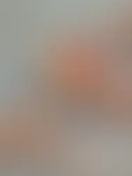 Chiapas con alta prevalencia de casos de cáncer cervicouterino