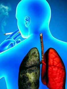 Sin acceso a tratamiento, 70% de enfermos con cáncer de pulmón