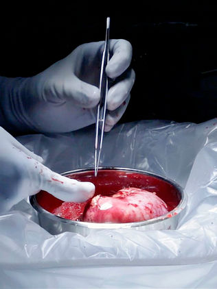 Riñones con hepatitis C reducirían tiempos de espera en transplantes