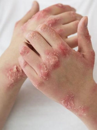 ¿Cómo afecta la psoriasis a la familia de quien la padece?