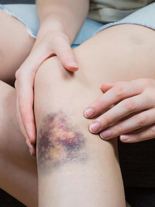 Sie7e de cada 10 casos de hemofilia son hereditarios