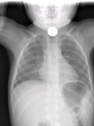 Ingestión de cuerpos extraños en niños es un peligro recurrente