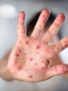 Especialista ve aumento de casos de sarampión en México