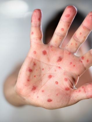 Descartan propagación de casos de sarampión en el país