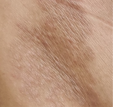 Eczema_edited.png