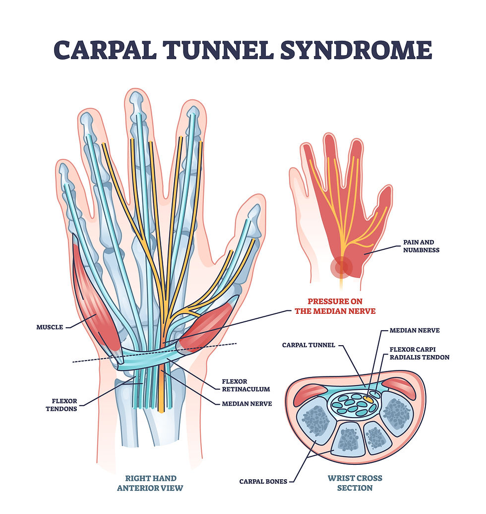 Diagram showing the anatomy of the carpal tunnel with the median nerve being compressed inside the tunnel