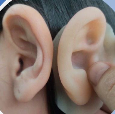 Protesis en silicona para personas que nacen si oreja o la pierden por cualquier accidente