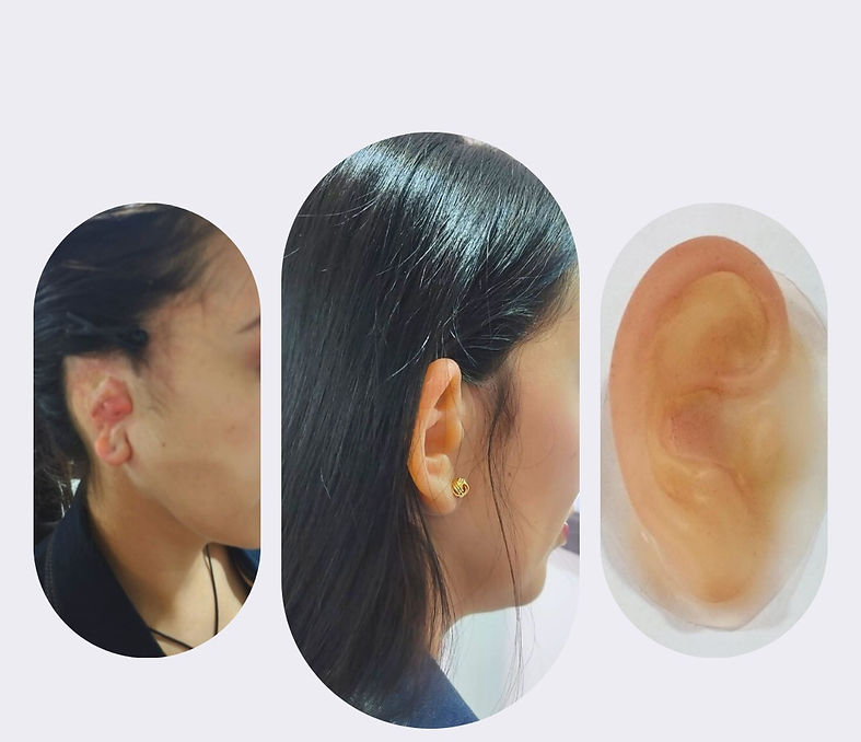 protesis hiperrealistas en 3d para personas que por culpa de accidentes o por cancer no tienen parte de su cuerpo, como senos, dedos, orejas, nariz, mano