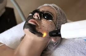 Struggling With Acne, Tan or Texture? This 20-Minute Hollywood Carbon Laser Peel Is a Reset Button