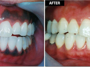 Dark Gums Making You Smile Less? Here’s the Laser Fix You Didn’t Know Existed