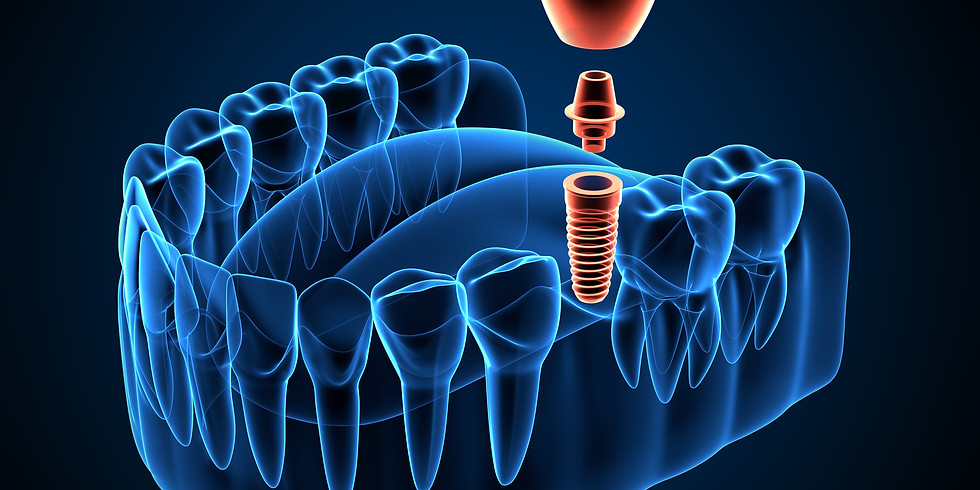 Formation : Initiation à la chirurgie implantaire