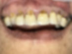 Anterior Crowns