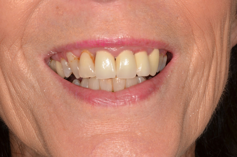 Anterior Crowns