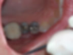 CEREC Before