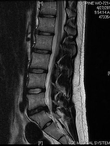 Herniated-Disc.jpg