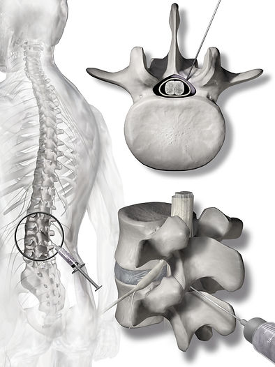 Blausen_0354_EpiduralSteroidInjection_ed