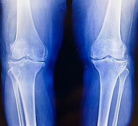 960px-Varus_Knee_Osteoarthritis_Xray.jpg