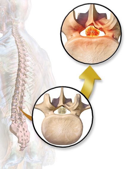 Spinal_Stenosis.png