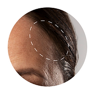 Sculptra 塑然雅童顏針適用部位_頭