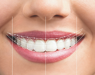 smile-design-6-1160x820.png