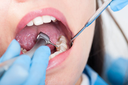 Dental fillings.jpeg