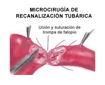 cuanto cuesta una cirugia de reconstruccion de trompas