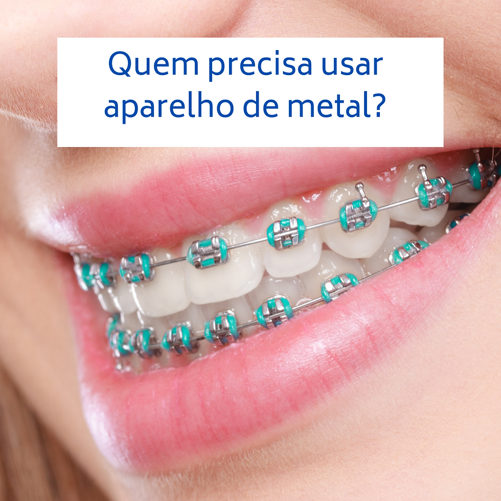 Quem precisa usar aparelho metálico?