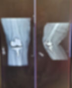 xray-orthopedic-surgery-full-knee-joint-replacemen-CSJTEYF.jpg