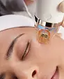 Microneedling
