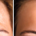 Anti Wrinkle Treatment for Forehead Lines
