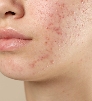 acne.png