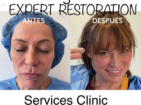 Tratamiento de Restauracion Facial Nanofat