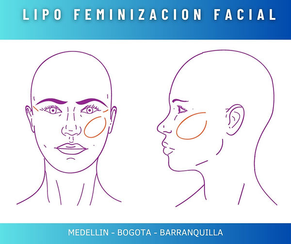 FFS FEMINIZACION FACIAL LIPO BARRANQUILLA BOGOTA MEDELLIN.jpeg