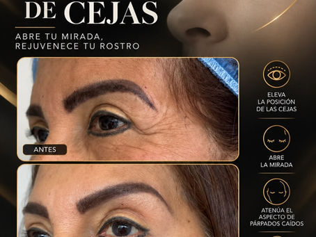 Lifting de cejas quirúrgico en Bogotá, Zona Norte | Dra. Amy Barreto