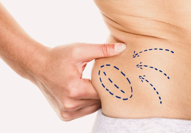 Alternativas médicas efectivas a la liposucción en Barranquilla: Criolipólisis e Hidrolipoclasia
