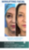 MINILIFTING FACIAL