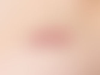 Cicatrices Queloides medellin Barranquilla Bogota