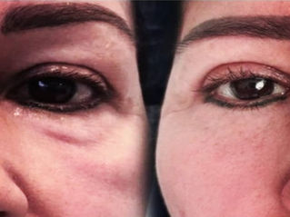 Blefaroplastia inferior y reparación del SOOF: rejuvenecimiento integral del tercio medio facial por la Dra. Amy Barreto