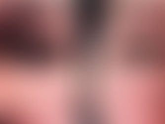 Blefaroplastia inferior y reparación del SOOF: rejuvenecimiento integral del tercio medio facial por la Dra. Amy Barreto