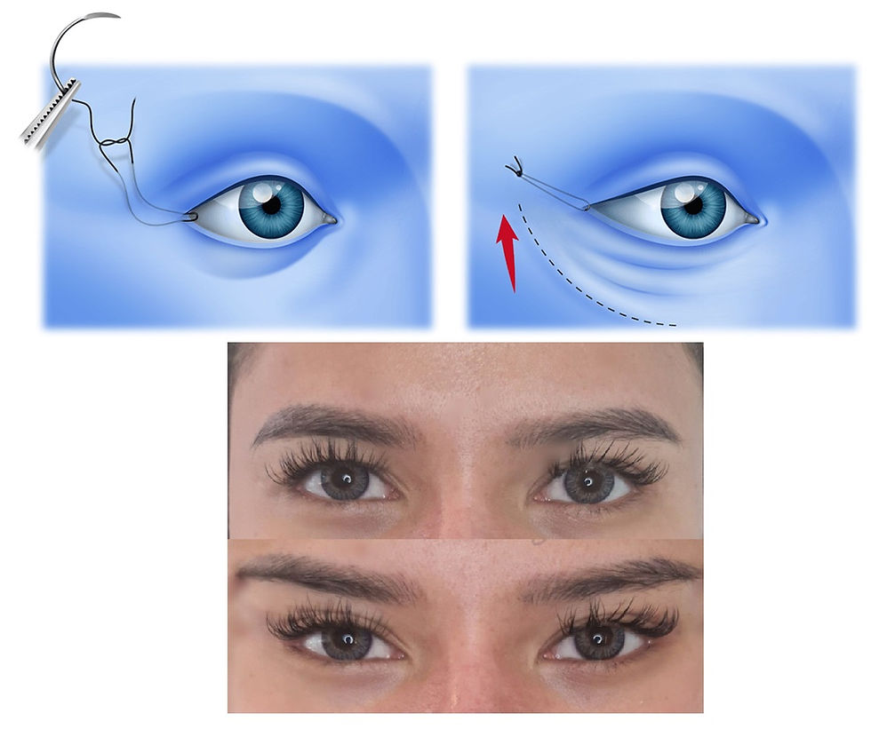 Foxy Eyes Quirúrgico y Blefaroplastia en Barranquilla