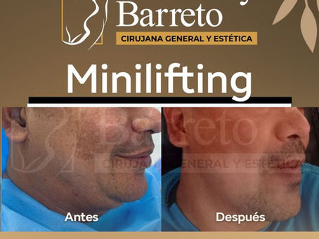 Proceso del Mini Lifting: