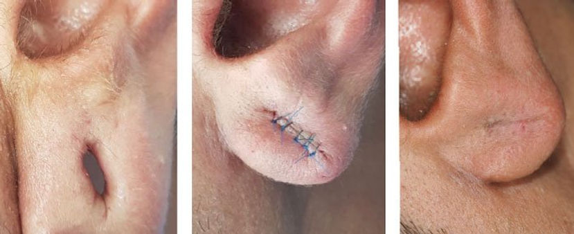 lobuloplastia medellin bogota.jpg
