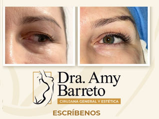 Pexia de Cejas: Rejuvenecimiento Natural de la Mirada