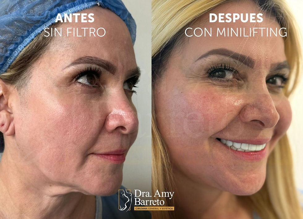 Minilifting Facial  Dra. Amy Barreto: Rejuvenecimiento Natural, Rápido y Accesible”